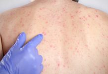 Casos de sarampo são confirmados na região