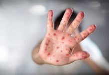 Jovem de 18 anos foi confirmado com sarampo