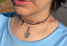 Jovem sofre acidente com fio solto na rua